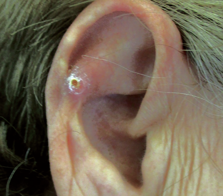 Can You Identify This Tender Nodule on a Woman’s External Ear? Consultant360